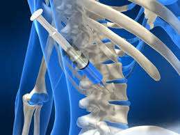 Interventional Pain Management